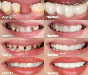 1 SET DIAMOND SMILE VENEERS (OBEN & UNTEN ZÄHNE)