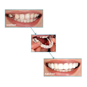 1 SET DIAMOND SMILE VENEERS (OBEN & UNTEN ZÄHNE)