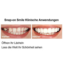 Laden Sie das Bild in den Galerie-Viewer, 1 SET DIAMOND SMILE VENEERS (OBEN &amp; UNTEN ZÄHNE)
