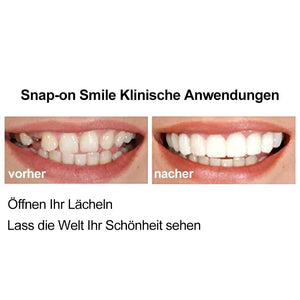 1 SET DIAMOND SMILE VENEERS (OBEN & UNTEN ZÄHNE)