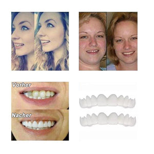 1 SET DIAMOND SMILE VENEERS (OBEN & UNTEN ZÄHNE)