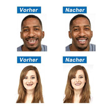 Laden Sie das Bild in den Galerie-Viewer, 1 SET DIAMOND SMILE VENEERS (OBEN &amp; UNTEN ZÄHNE)
